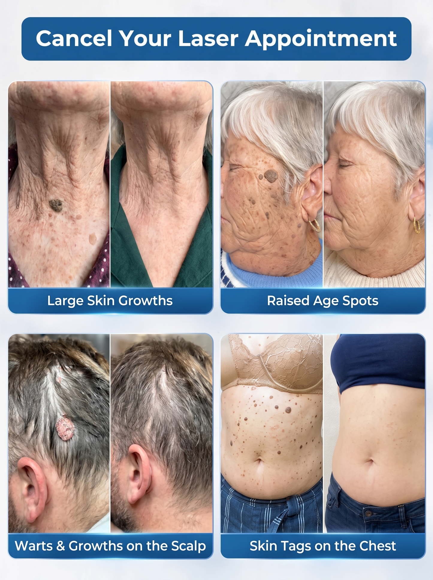 DermaErase™ – Precision Roll-On for Warts, Skin Tags & Blemishes