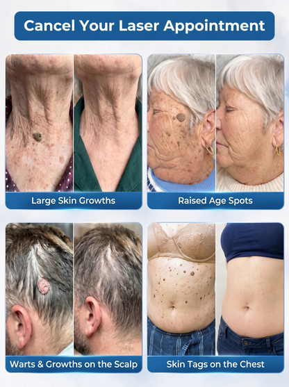 DermaErase™ – Precision Roll-On for Warts, Skin Tags & Blemishes